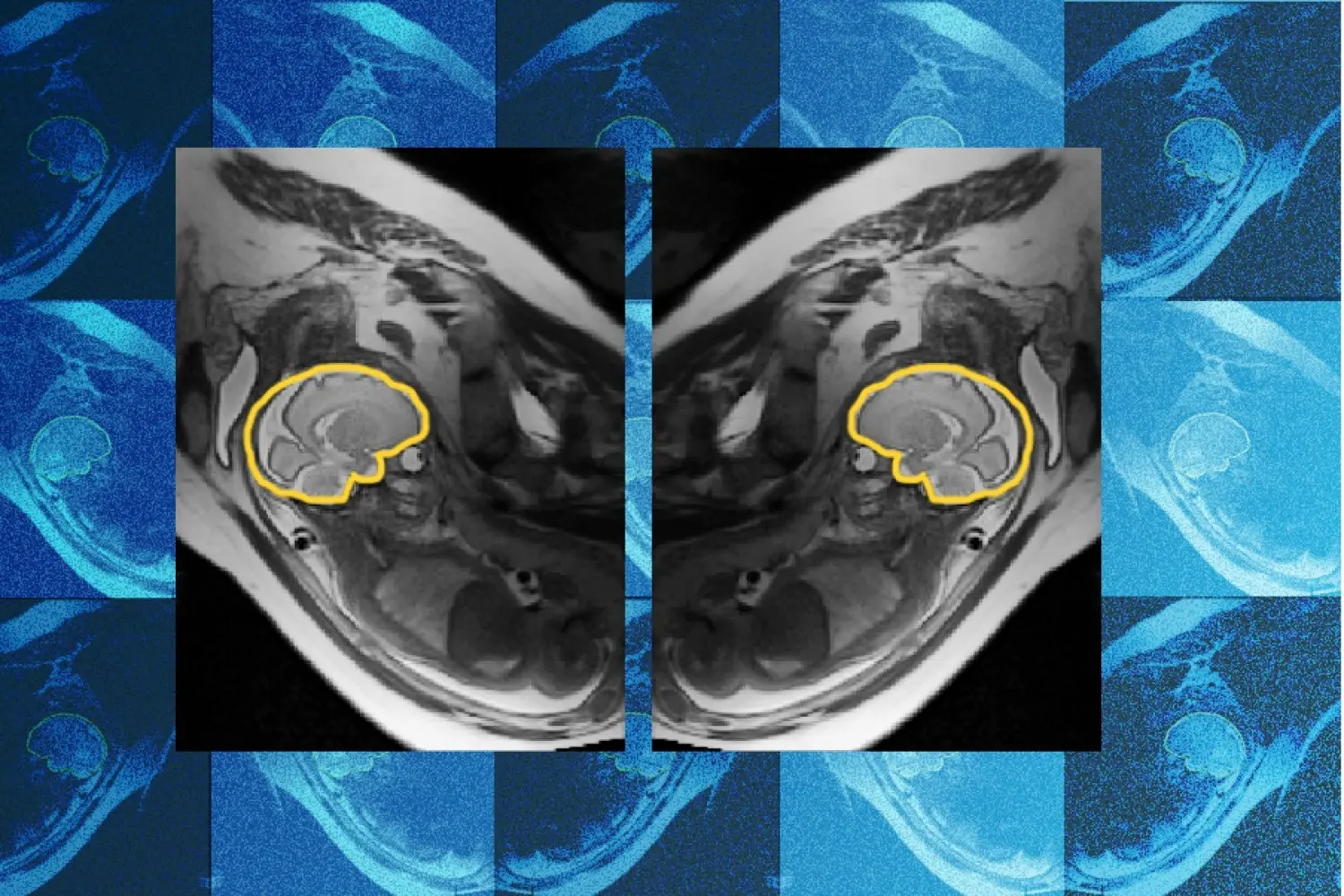MIT-model volgt bewegend hoofd van ongeboren baby voor scherpere MRI-scans